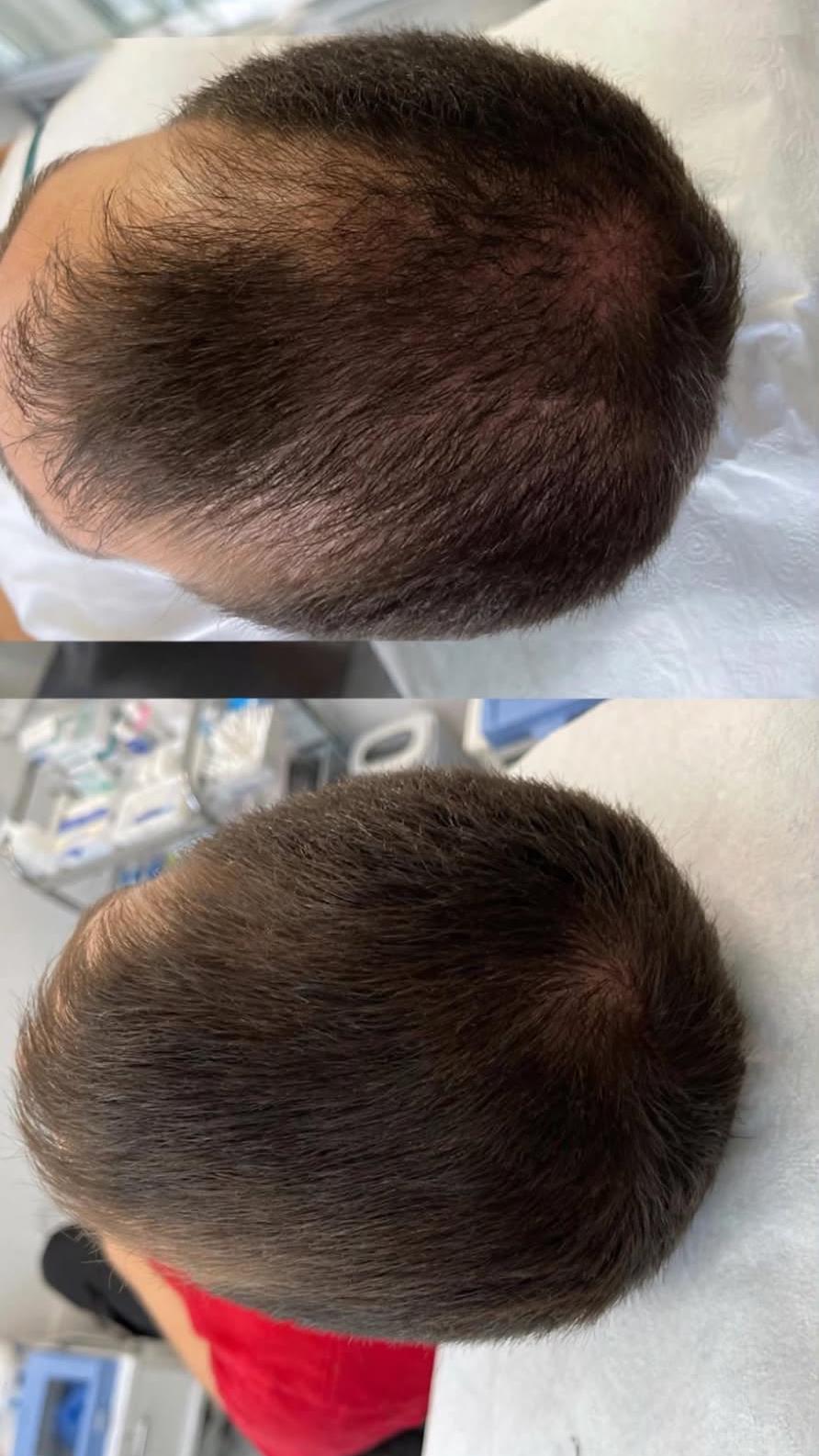 Comparativo de evolução capilar de um cliente, antes e depois do acompanhamento