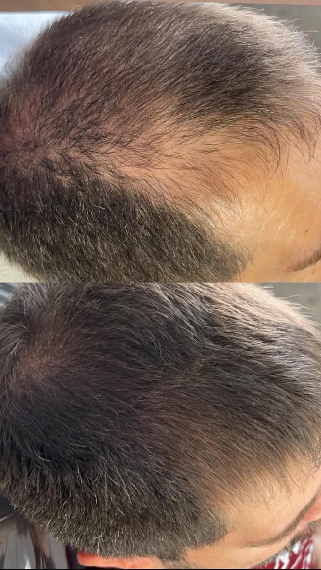 Comparativo de evolução capilar de um cliente, antes e depois do acompanhamento